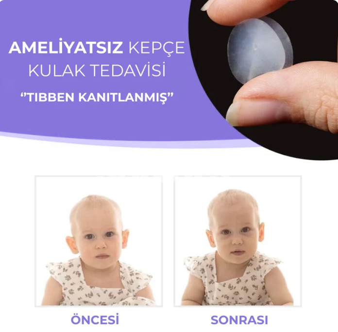 Jormaria® Kepçe Kulak Düzeltme Bandı